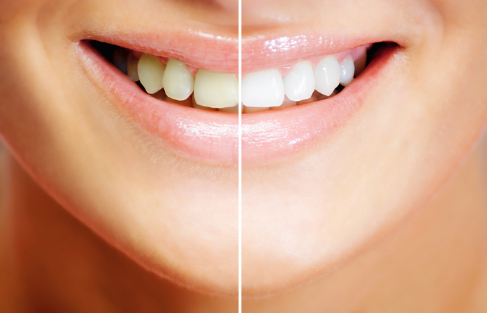 炭酸水素塩配合ホワイトニング