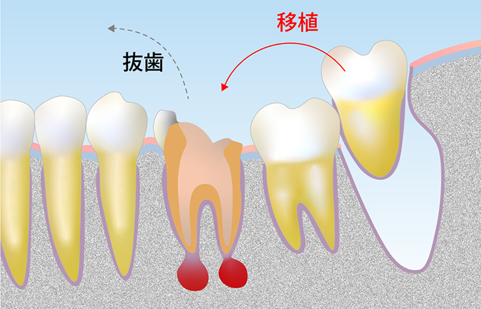 自然な噛み心地を実現できる歯牙移植