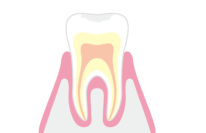 C0(初期のむし歯)