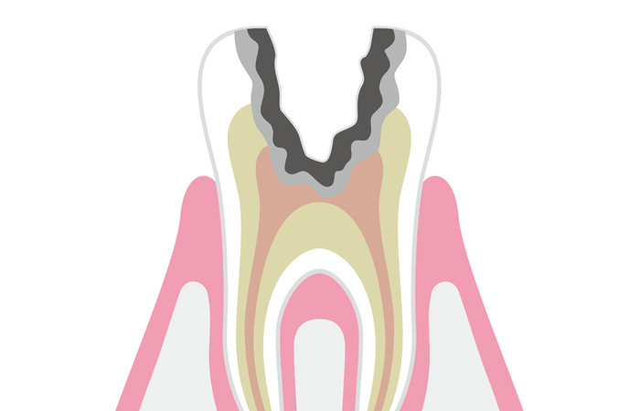 C3(神経まで進んだむし歯)