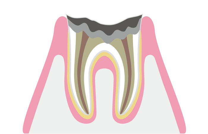 C4(重度のむし歯)
