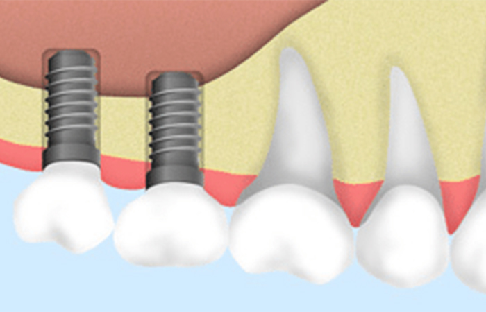 ソケットリフト