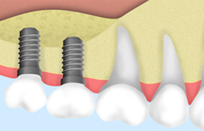 サイナスリフト