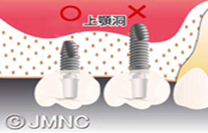 ショートインプラント