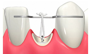 インビザラインGo