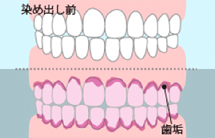 プラークの染め出し