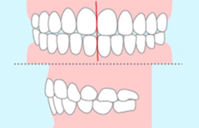 かみ合わせチェック