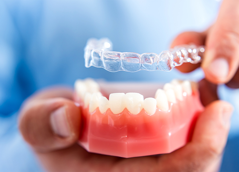 マウスピース矯正