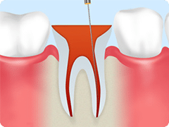 抜髄根管治療
