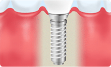 インプラント