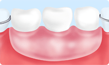 入れ歯（保険適用）