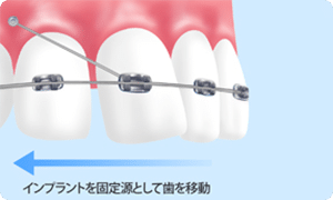 インプラント矯正