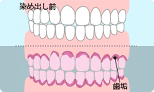 プラークの染出し